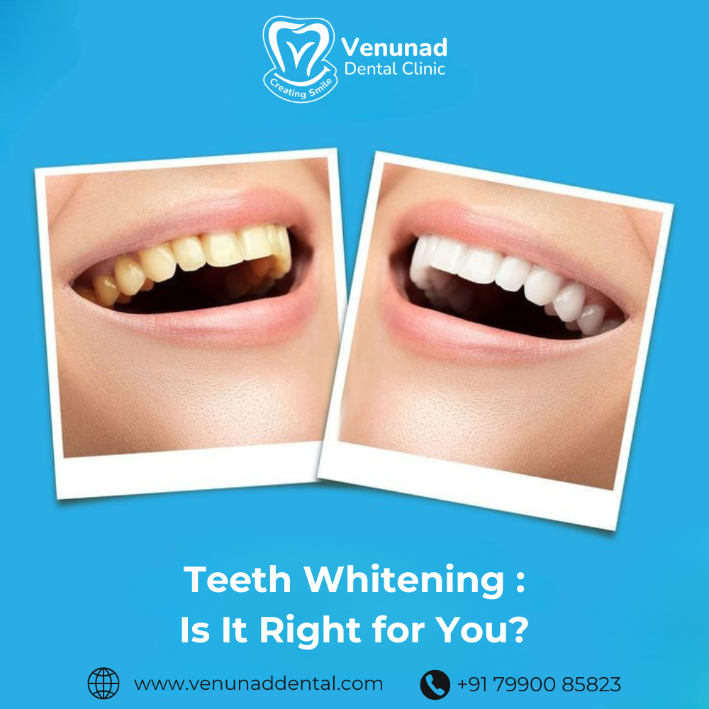 https://www.venunaddental.com.lttrbx.in/uploaded_file/files/img/news/Teeth Whitening